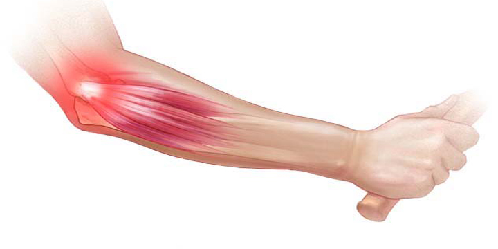 Treatment for tennis elbow