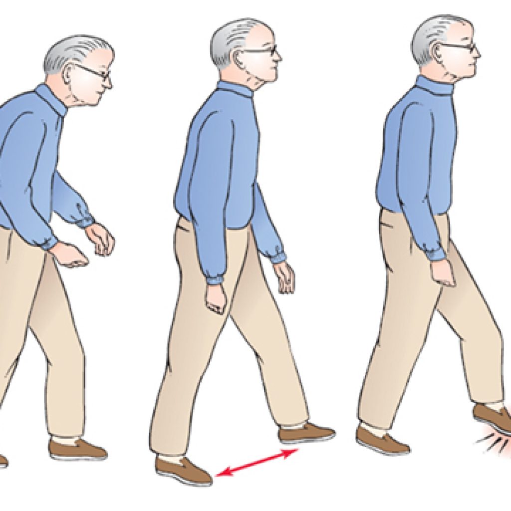 gait abnormalities
